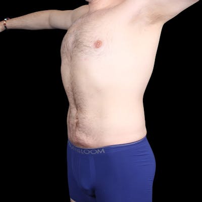 Liposuction Before & After Gallery - Patient 327784 - Image 2