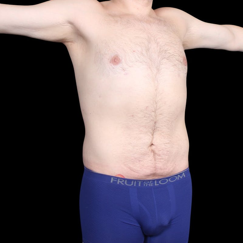 Liposuction Before & After Gallery - Patient 327784 - Image 8