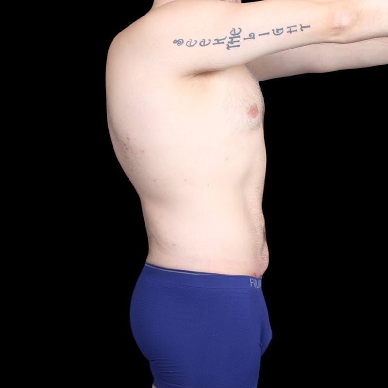 Liposuction Before & After Gallery - Patient 327784 - Image 10
