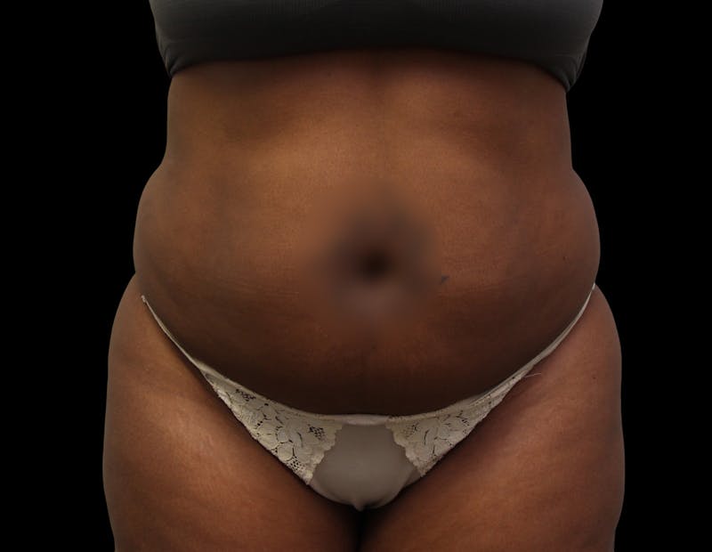 Liposuction Before & After Gallery - Patient 144660 - Image 3