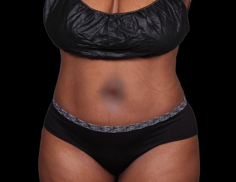 Liposuction Before & After Gallery - Patient 144660 - Image 4