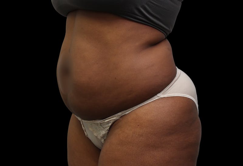 Liposuction Before & After Gallery - Patient 144660 - Image 1