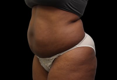 Liposuction Before & After Gallery - Patient 144660 - Image 1