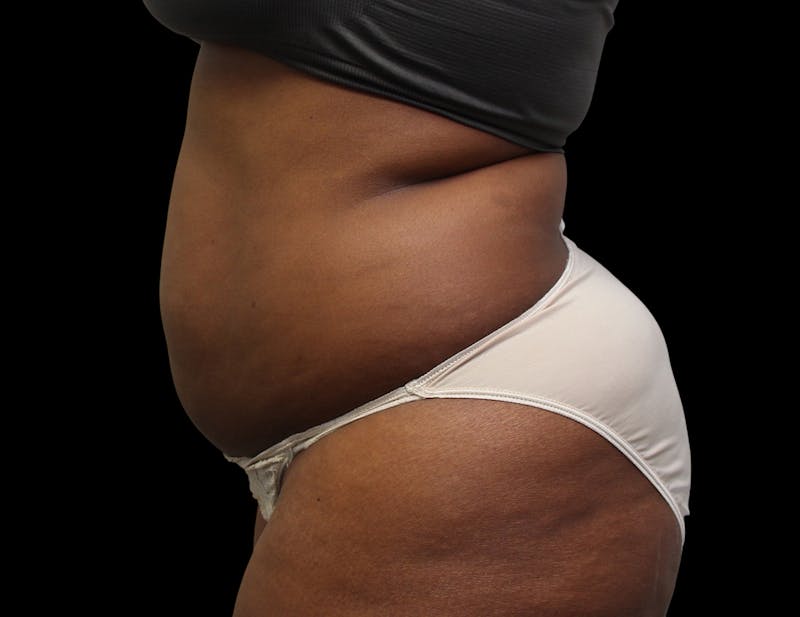 Liposuction Before & After Gallery - Patient 144660 - Image 9