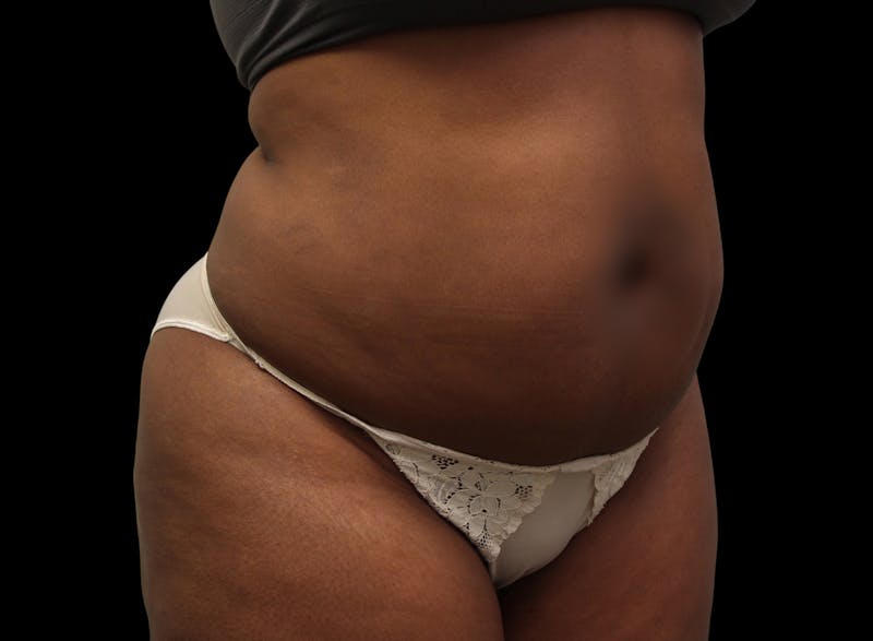 Liposuction Before & After Gallery - Patient 144660 - Image 5