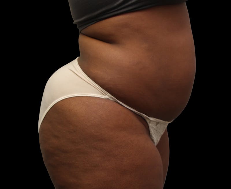 Liposuction Before & After Gallery - Patient 144660 - Image 7