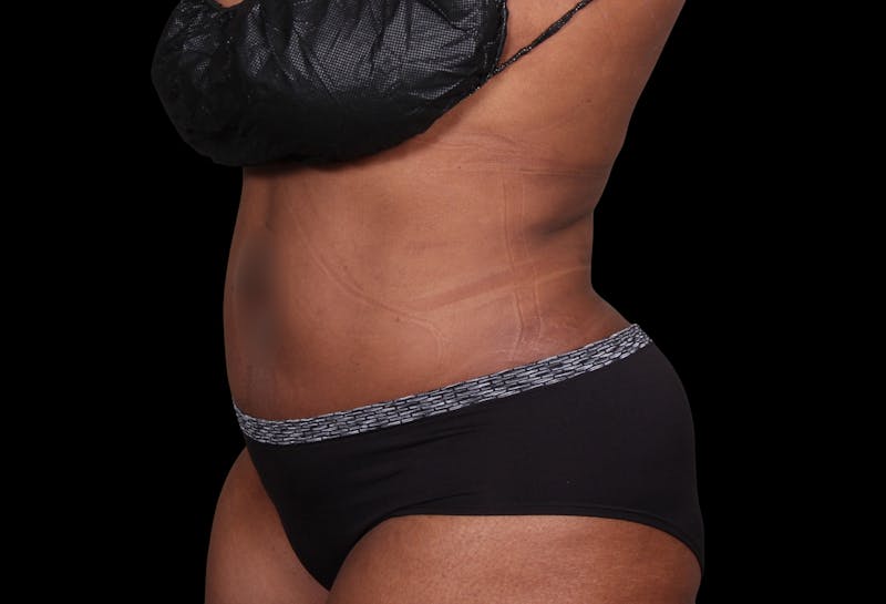 Liposuction Before & After Gallery - Patient 144660 - Image 2