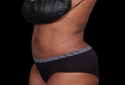 Liposuction Before & After Gallery - Patient 144660 - Image 2