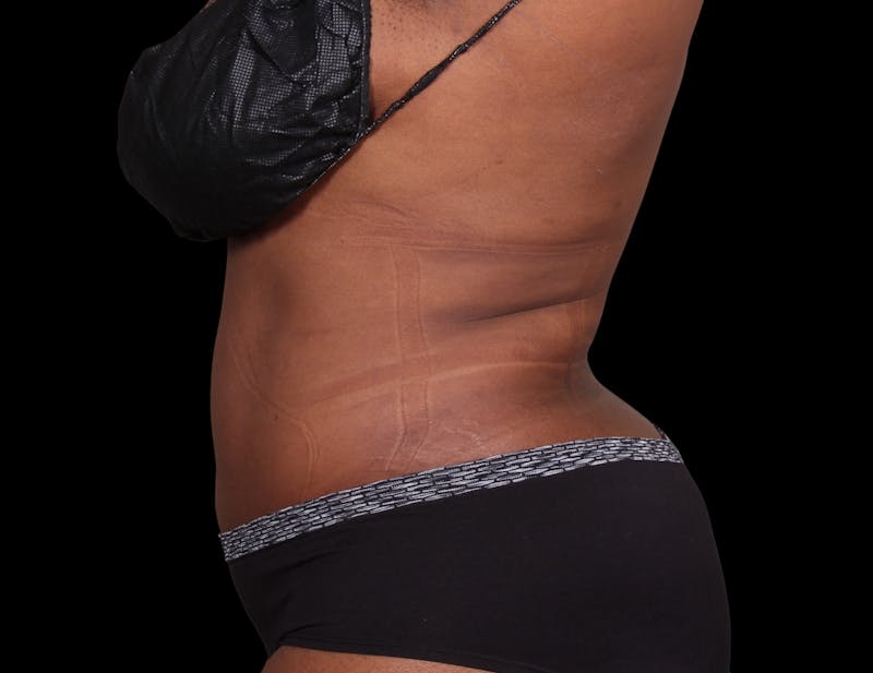 Liposuction Before & After Gallery - Patient 144660 - Image 10