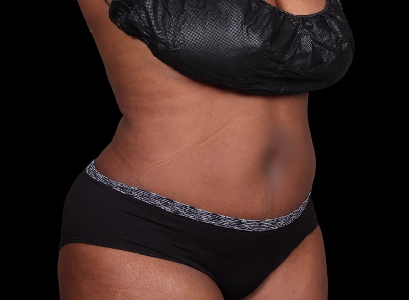 Liposuction Before & After Gallery - Patient 144660 - Image 6