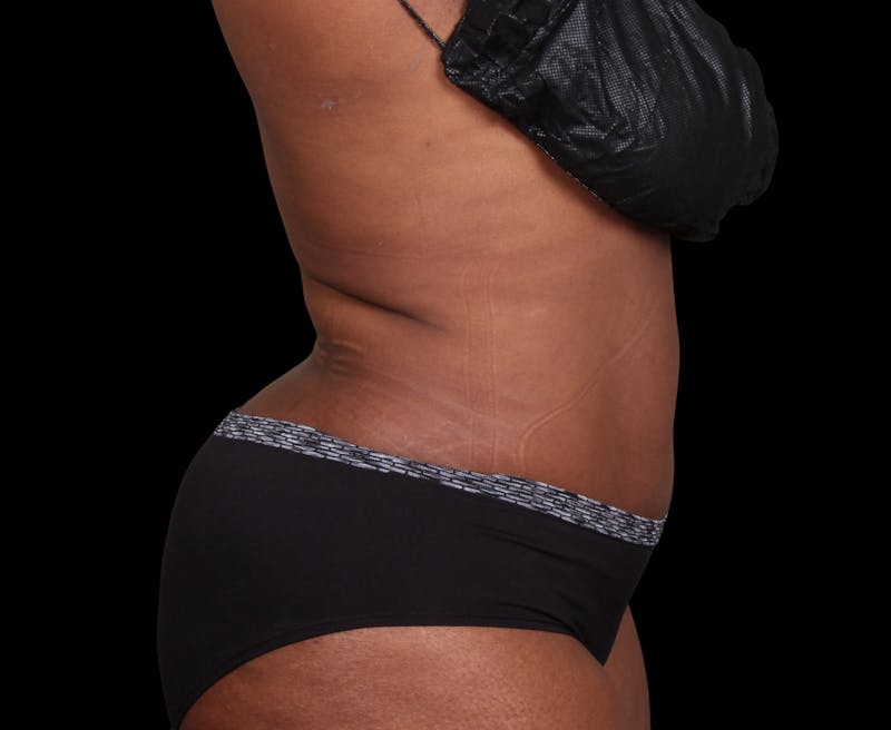 Liposuction Before & After Gallery - Patient 144660 - Image 8