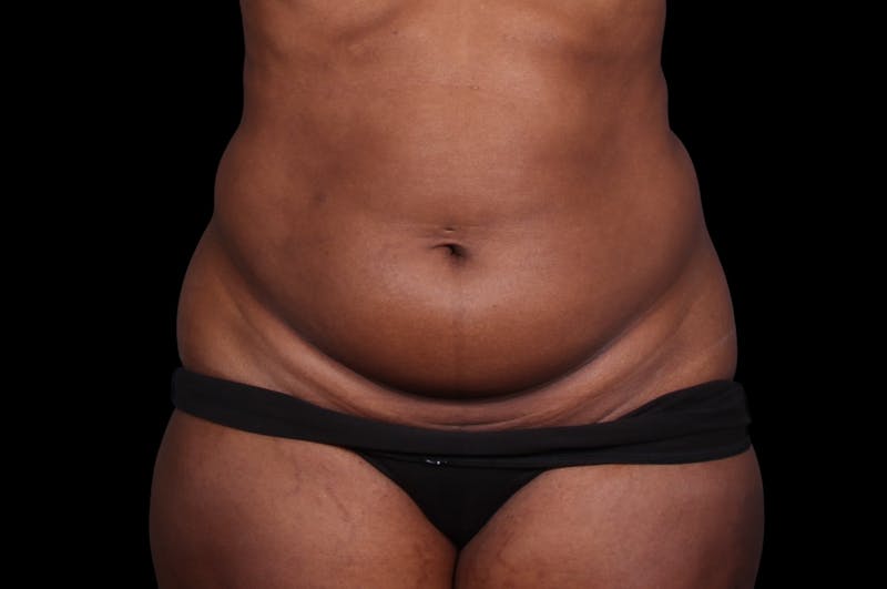 Liposuction Before & After Gallery - Patient 298839 - Image 3