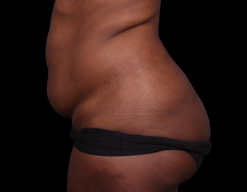 Liposuction Before & After Gallery - Patient 298839 - Image 9