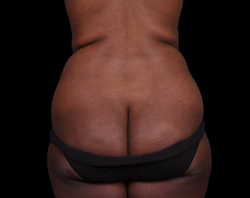 Liposuction Before & After Gallery - Patient 298839 - Image 11