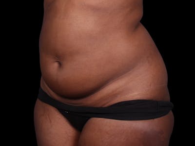 Liposuction Before & After Gallery - Patient 298839 - Image 1