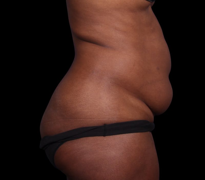 Liposuction Before & After Gallery - Patient 298839 - Image 7
