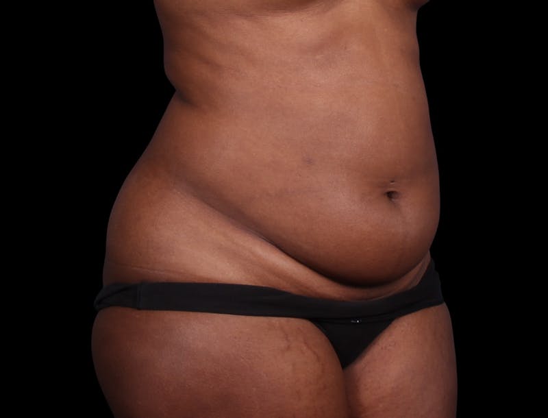 Liposuction Before & After Gallery - Patient 298839 - Image 5
