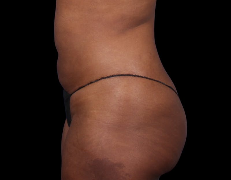 Liposuction Before & After Gallery - Patient 298839 - Image 10