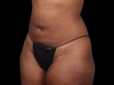 Liposuction Before & After Gallery - Patient 298839 - Image 2