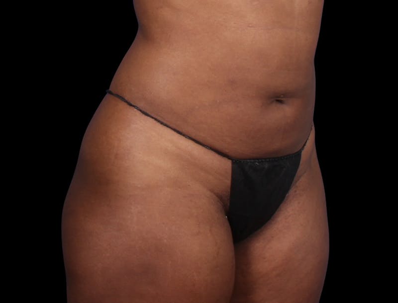 Liposuction Before & After Gallery - Patient 298839 - Image 6