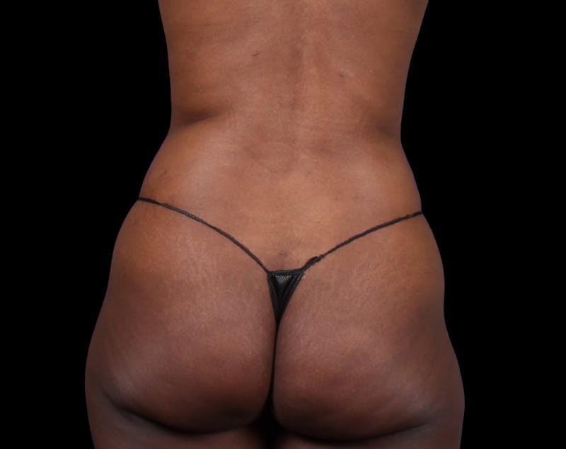 Liposuction Before & After Gallery - Patient 298839 - Image 12