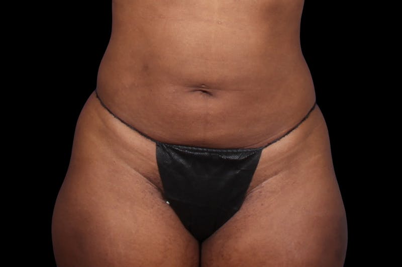 Liposuction Before & After Gallery - Patient 298839 - Image 4