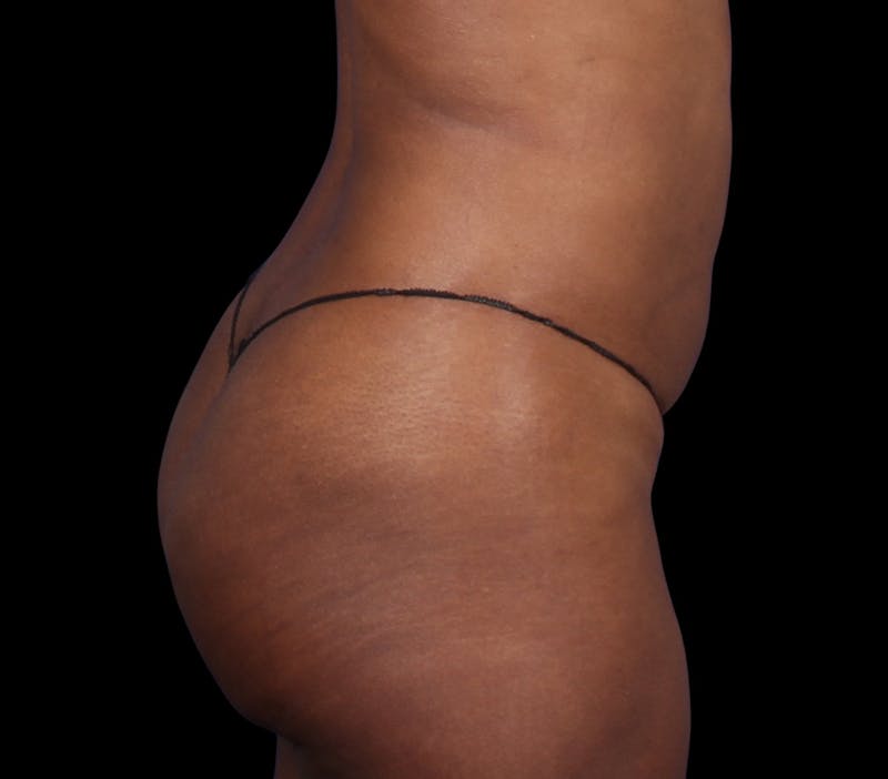 Liposuction Before & After Gallery - Patient 298839 - Image 8