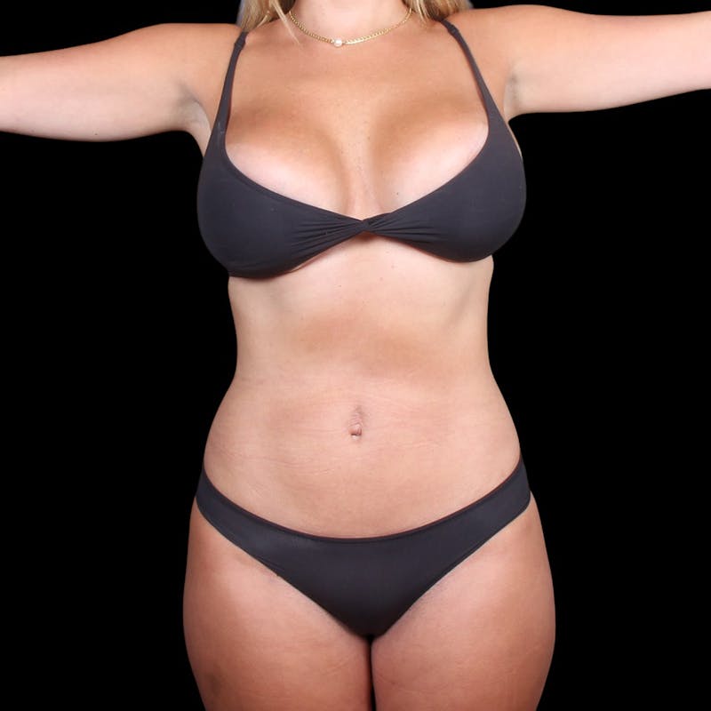 Liposuction Before & After Gallery - Patient 372377 - Image 4