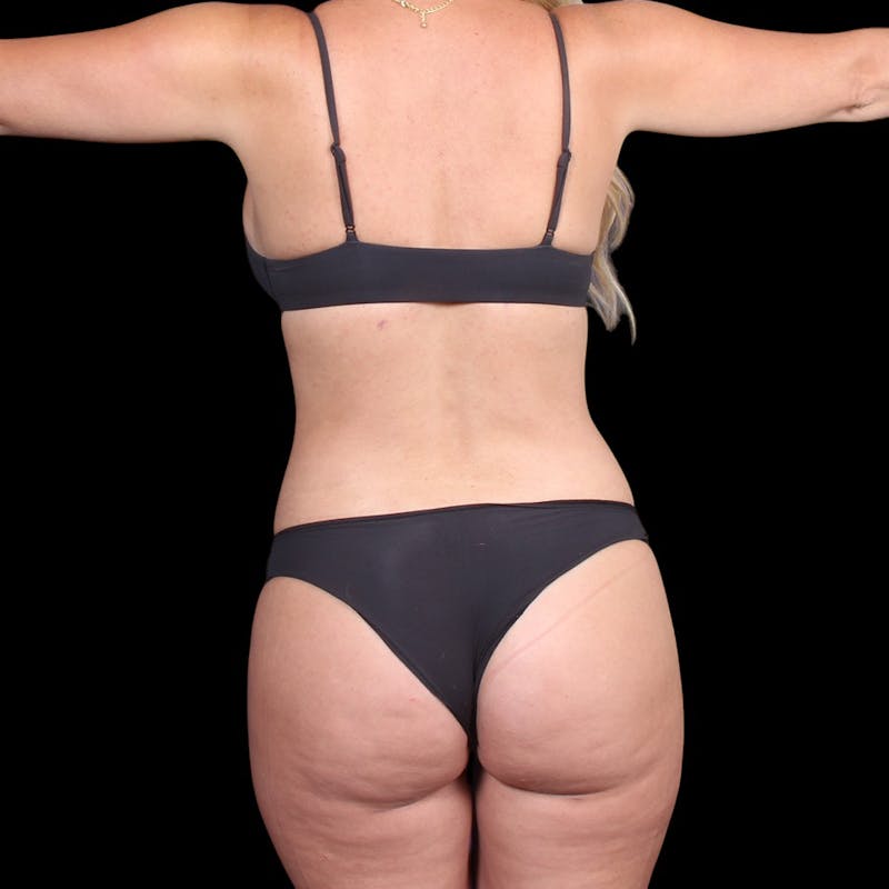 Liposuction Before & After Gallery - Patient 372377 - Image 12