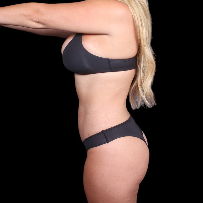 Liposuction Before & After Gallery - Patient 372377 - Image 10