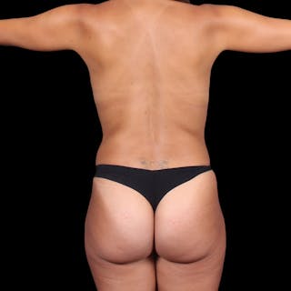 Liposuction Before & After Gallery - Patient 352815 - Image 12