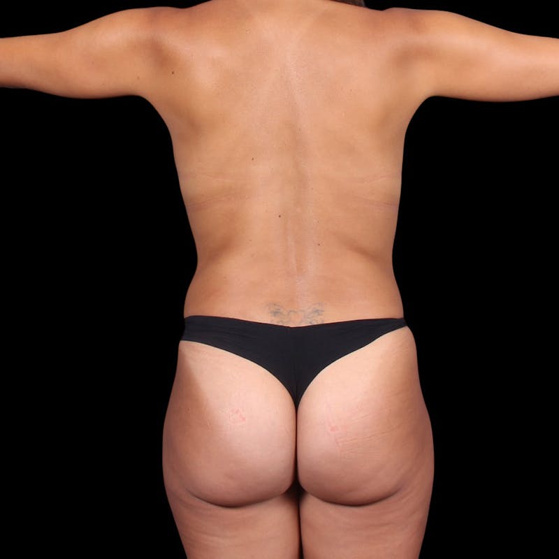 Liposuction Before & After Gallery - Patient 352815 - Image 12