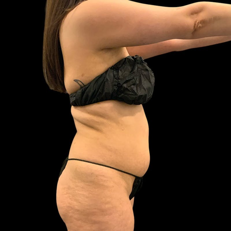 Liposuction Before & After Gallery - Patient 289001 - Image 7