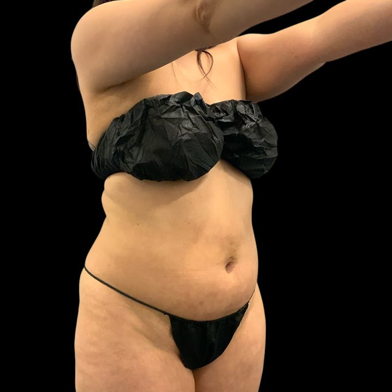 Liposuction Before & After Gallery - Patient 289001 - Image 5