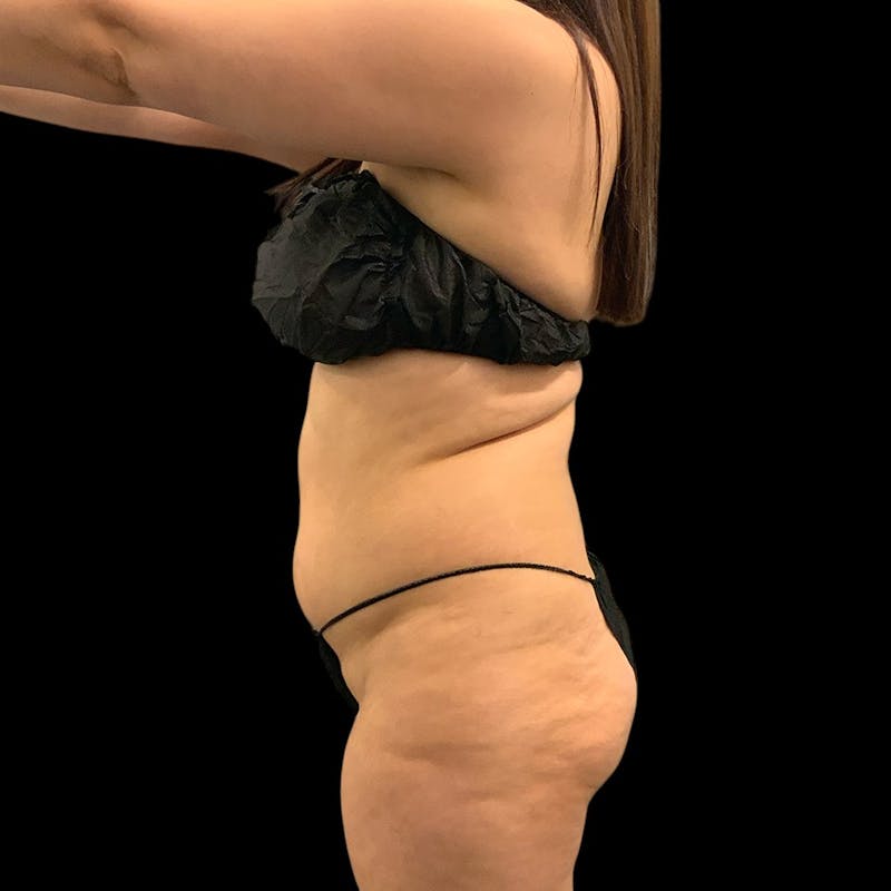 Liposuction Before & After Gallery - Patient 289001 - Image 9
