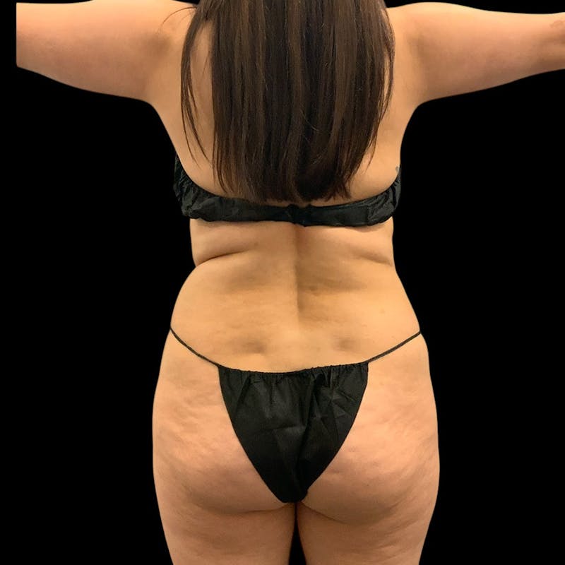 Liposuction Before & After Gallery - Patient 289001 - Image 11