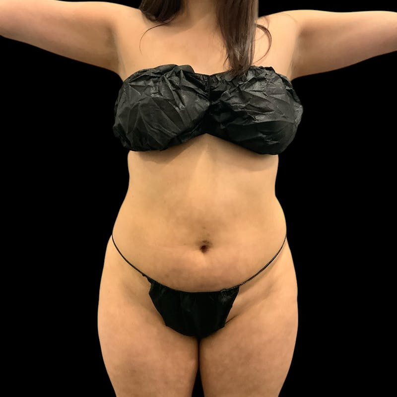 Liposuction Before & After Gallery - Patient 289001 - Image 3