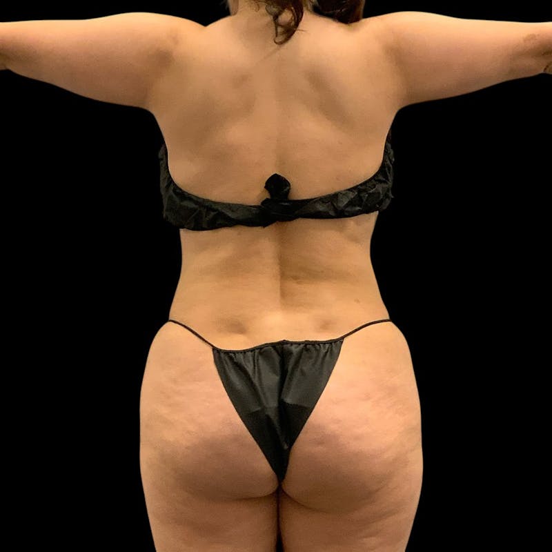 Liposuction Before & After Gallery - Patient 289001 - Image 12