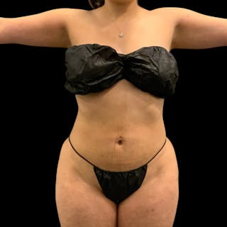 Liposuction Before & After Gallery - Patient 289001 - Image 4