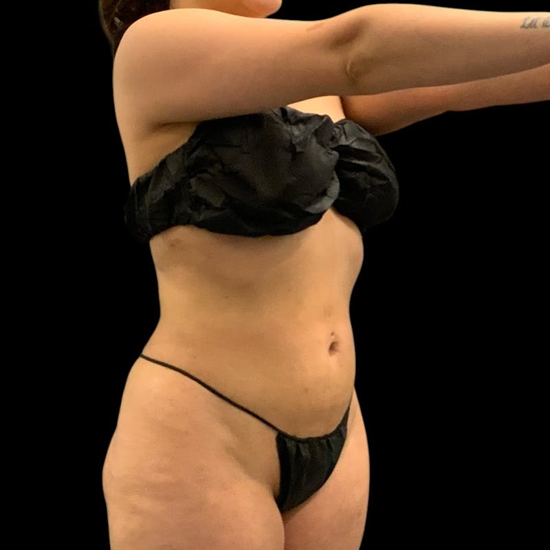 Liposuction Before & After Gallery - Patient 289001 - Image 6