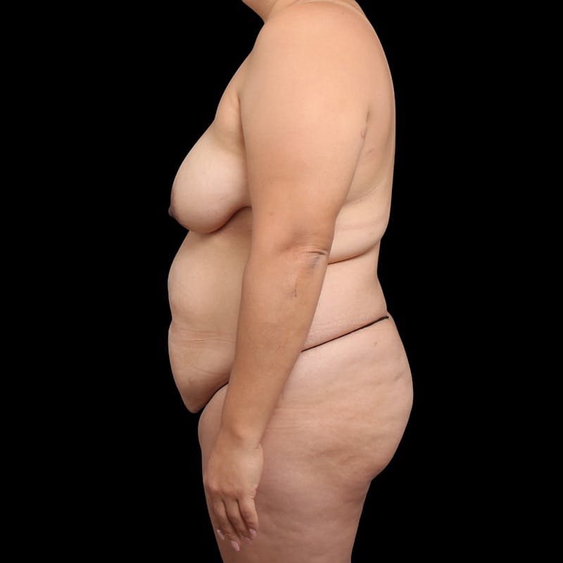 Mommy Makeover Before & After Gallery - Patient 319253 - Image 9