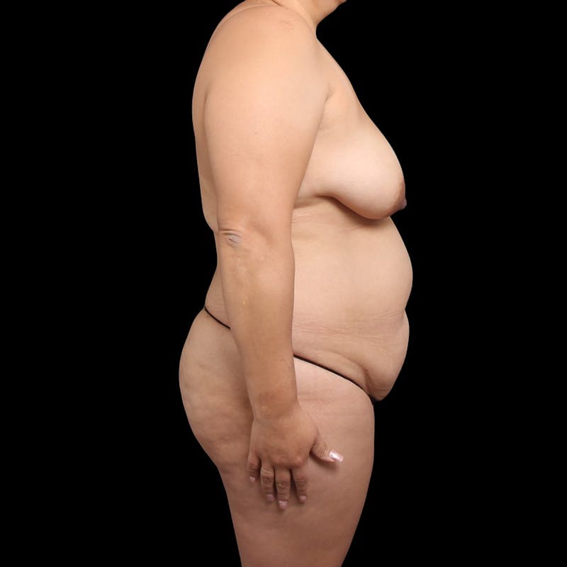 Mommy Makeover Before & After Gallery - Patient 319253 - Image 5