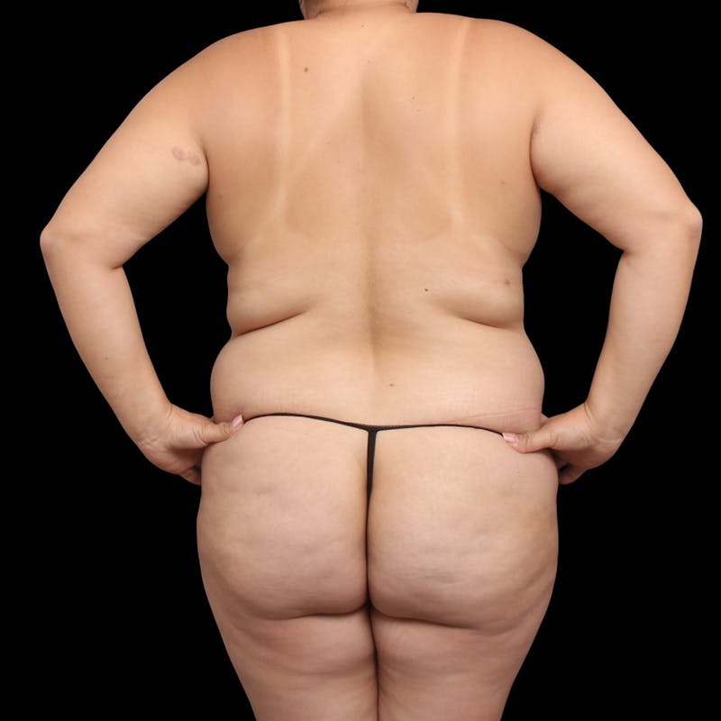 Mommy Makeover Before & After Gallery - Patient 319253 - Image 11