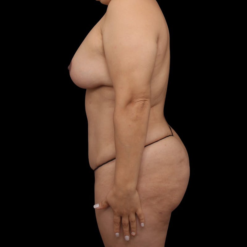 Mommy Makeover Before & After Gallery - Patient 319253 - Image 10