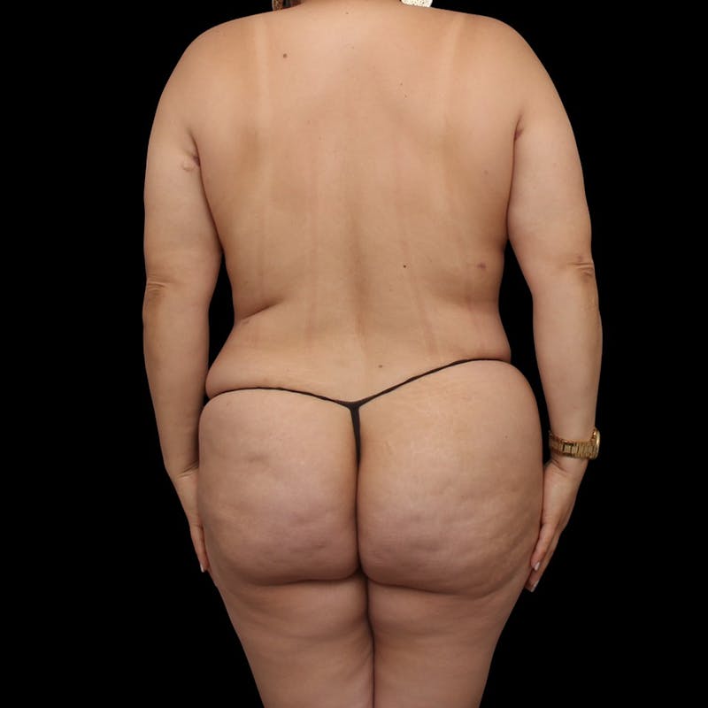 Mommy Makeover Before & After Gallery - Patient 319253 - Image 12