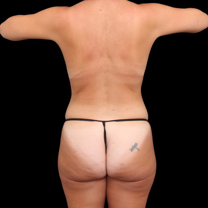 Mommy Makeover Before & After Gallery - Patient 158531 - Image 11