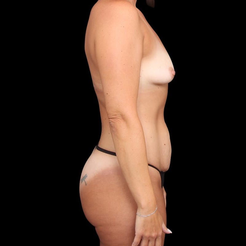 Mommy Makeover Before & After Gallery - Patient 158531 - Image 5