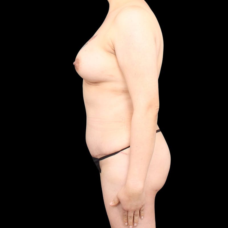 Mommy Makeover Before & After Gallery - Patient 198519 - Image 10