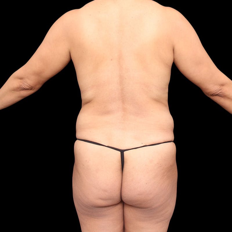Mommy Makeover Before & After Gallery - Patient 208485 - Image 11