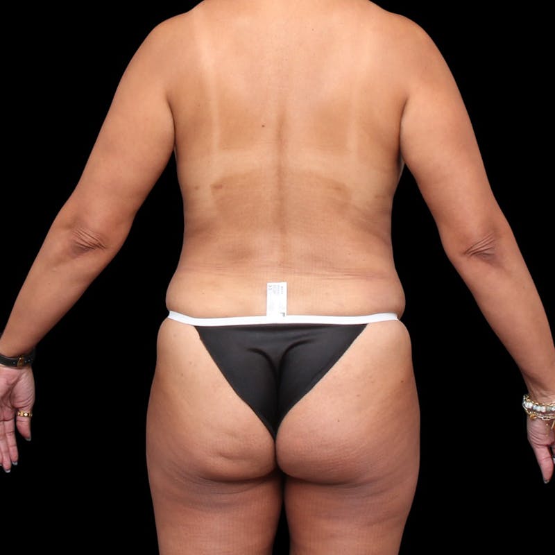 Mommy Makeover Before & After Gallery - Patient 208485 - Image 12